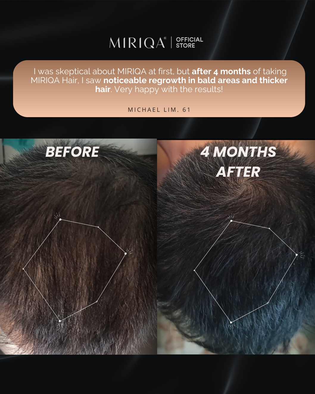 MIRIQA Hair Supplement - Hair Growth You Can See