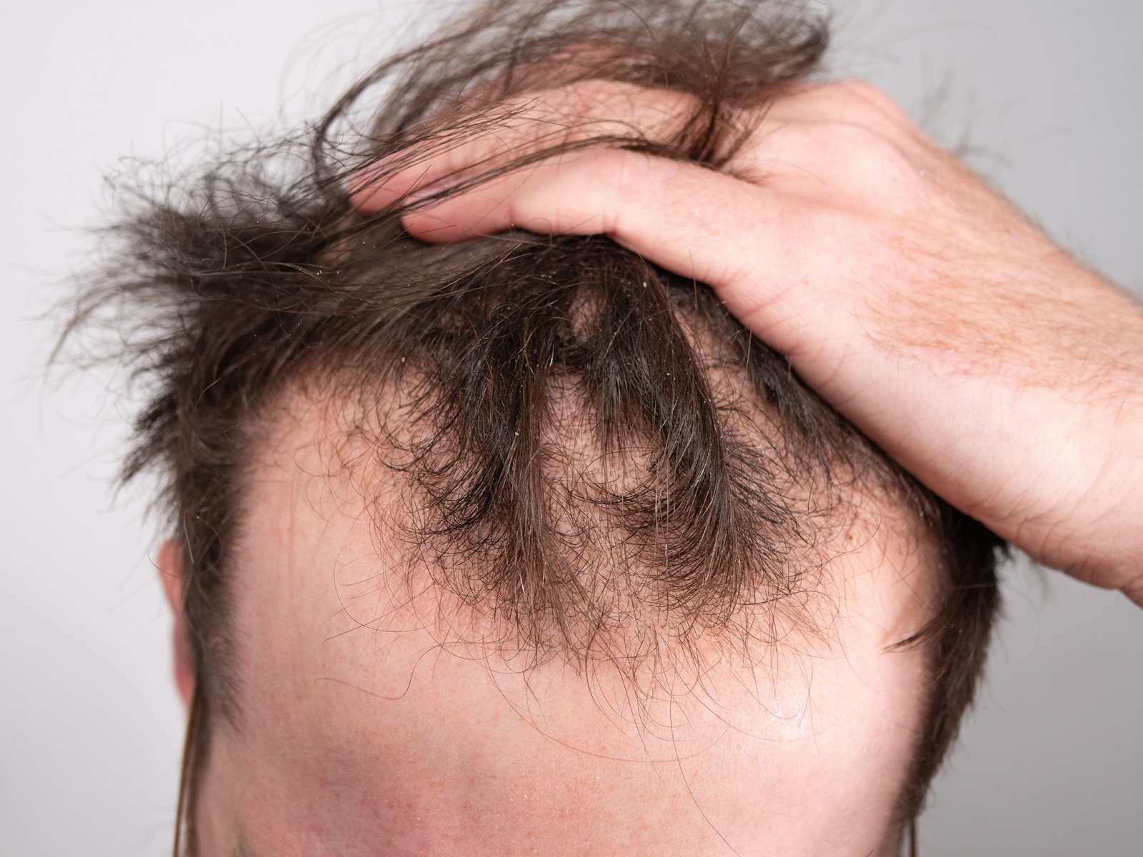 Men's Guide to Regrow Hair: Effective Solutions and Treatments