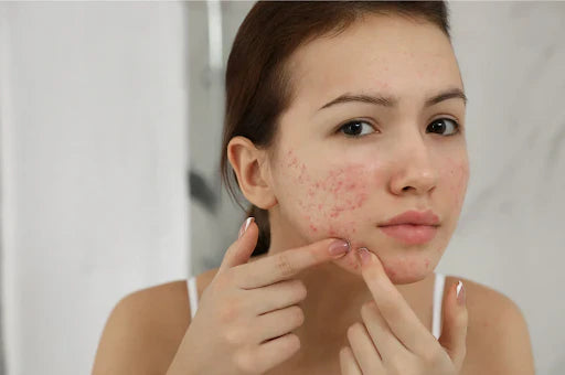 Acne Marks vs Acne Scars: How to Identify, Prevent, & Treat Each