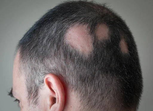 Alopecia Areata: Causes, Symptoms, Treatment, and Prognosis Explained