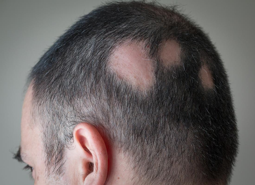 Alopecia Areata: Causes, Symptoms, Treatment, and Prognosis Explained