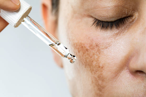 Is There a Way to Treat Melasma? Proven Melasma Treatment